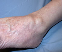 ankle ganglion